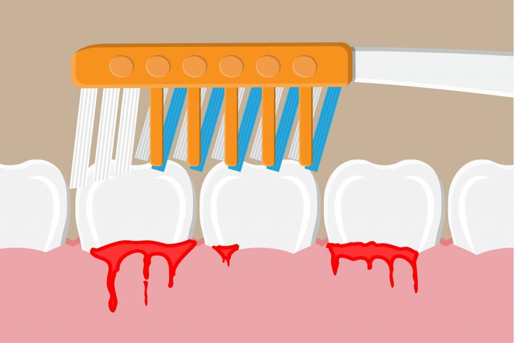 Ağız İçerisindeki Tehlike Diş Eti Kanaması