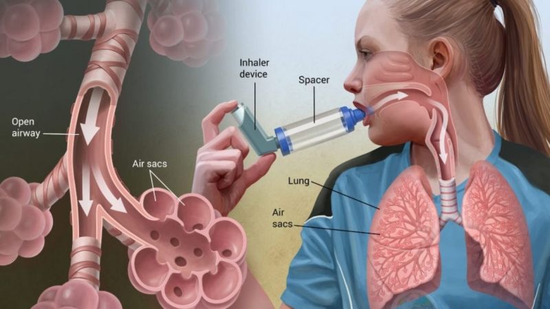 Kronik Hava Yolu Hastalıkları ve Tedavisi