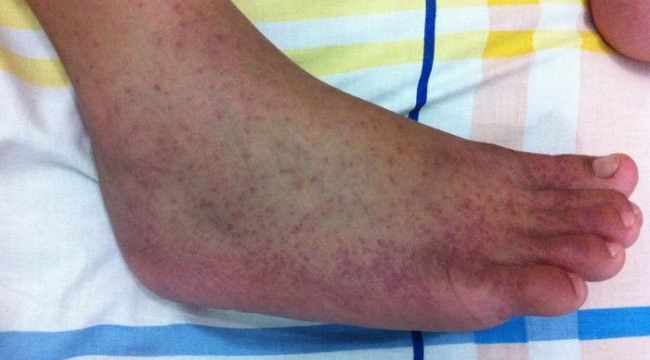Chikungunya  Hastalığının Belirtileri Kaç Günde Ortaya Çıkar?