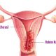 endometrium-rahim-kanseri-neden-olur-tanisi-nasil-konur-tedavisi-6054