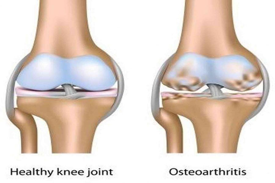 osteoartrit-neden-olur-tehlikeli-midir-tanisi-ve-tedavisi-mumkun-mudur-67698