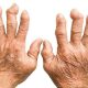 romatoid-artrit-iltihapli-romatizma-neden-olur-kimlerde-gorulur-tanisi-ve-tedavisi-20344