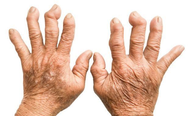 romatoid-artrit-iltihapli-romatizma-neden-olur-kimlerde-gorulur-tanisi-ve-tedavisi-20344