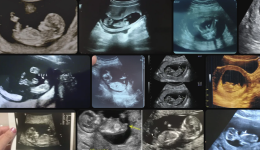 12 Haftalık Erkek Bebek Ultrasonda Nasıl Görünür? Nasıl Anlaşılır?