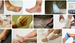 Parmakların Burkulmasına İncinmesine Ne İyi Gelir? Ayak Parmağı Burkulmasına Bitkisel Tedavi